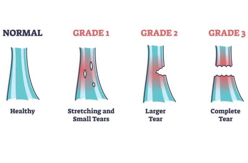 image showing grades of ligament injury