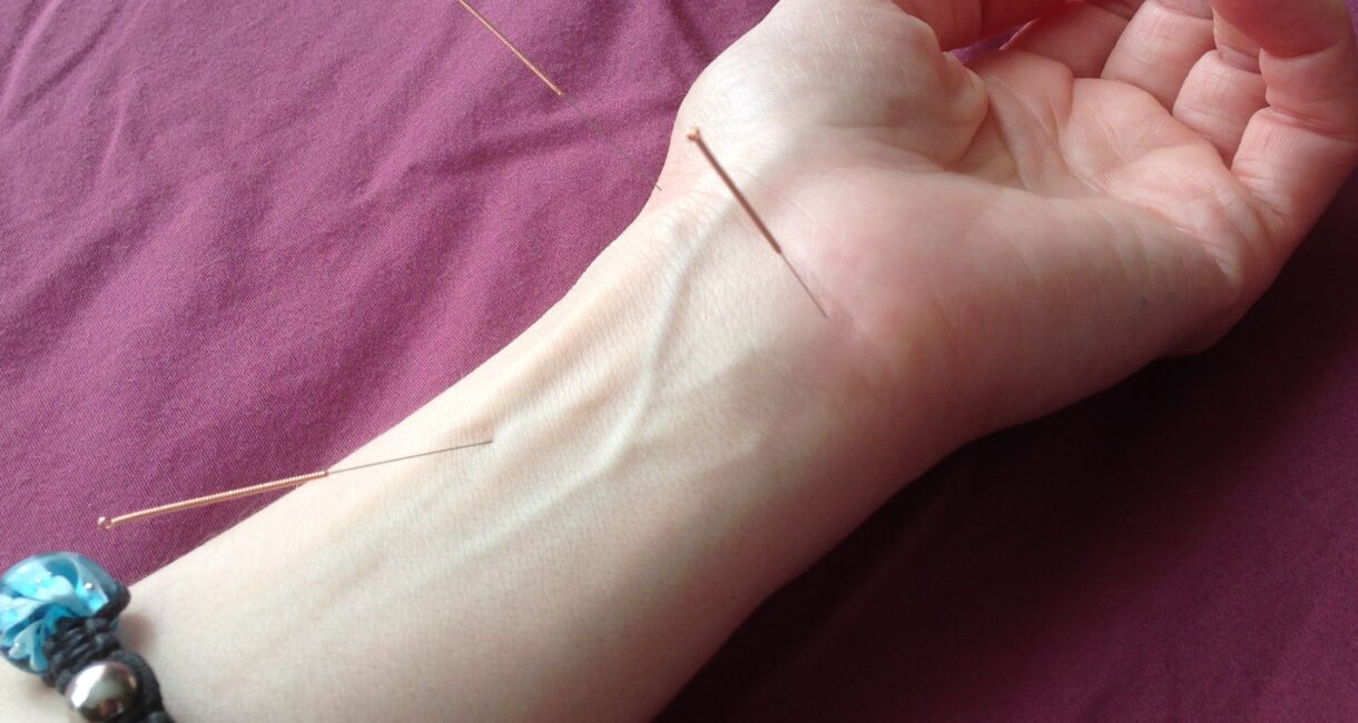 acupuncture in Calgary