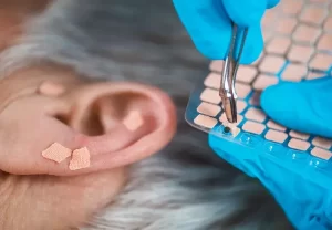 image of ear seeds being applied to ear