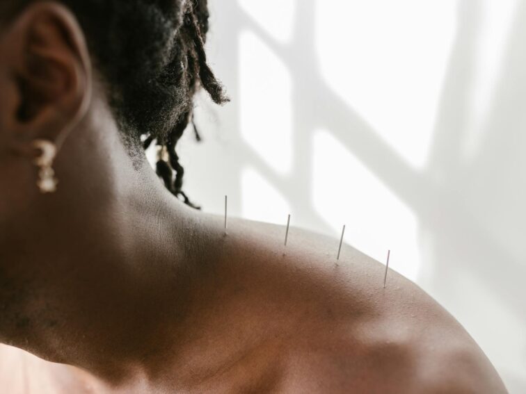 Insomnia Relief with Acupuncture