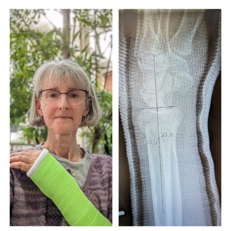 osteoporosis in menopause